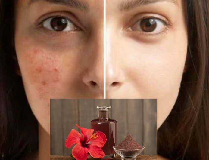 கரும்புள்ளிகள் (Dark spots) போகனுமா? அப்போ இதுதான் சிறந்தது..!
