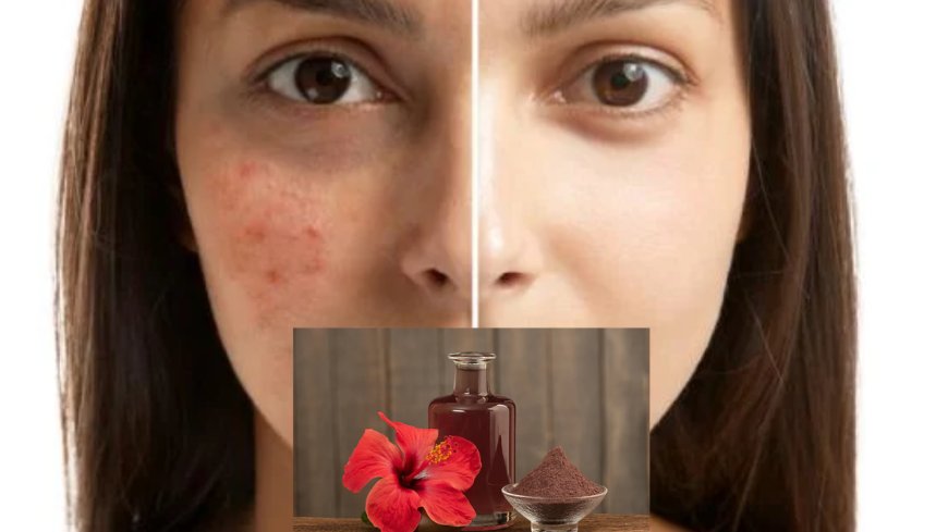கரும்புள்ளிகள் (Dark spots) போகனுமா? அப்போ இதுதான் சிறந்தது..!